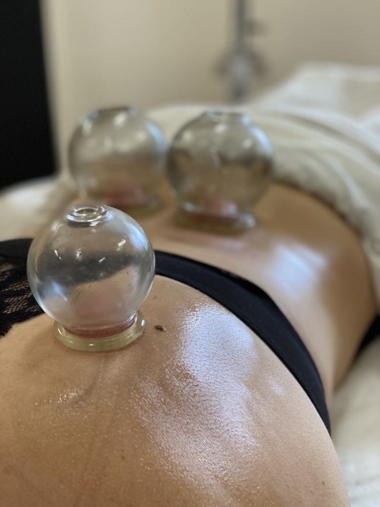 A glass therapy cup applied during treatment